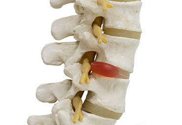 Spine with herniated disc