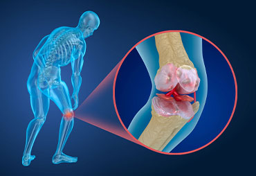 Diagram of knee joint with osteoporosis