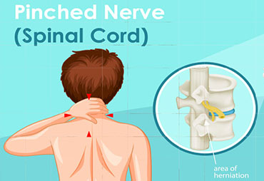Pinched nerve pain in spinal cord