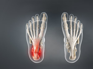 Treat Plantar Fasciitis Glendale