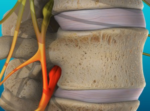 Treat Vertebral Subluxation Glendale