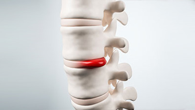 Patient suffering with herniated disc